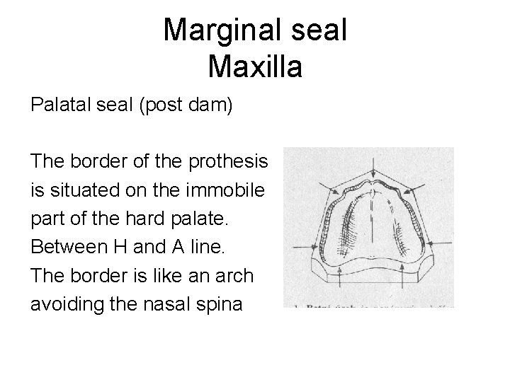 Marginal seal Maxilla Palatal seal (post dam) The border of the prothesis is situated