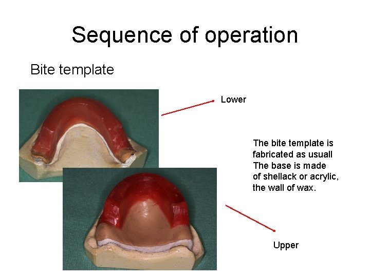 Sequence of operation Bite template Lower The bite template is fabricated as usuall The