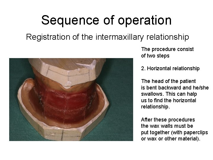 Sequence of operation Registration of the intermaxillary relationship The procedure consist of two steps