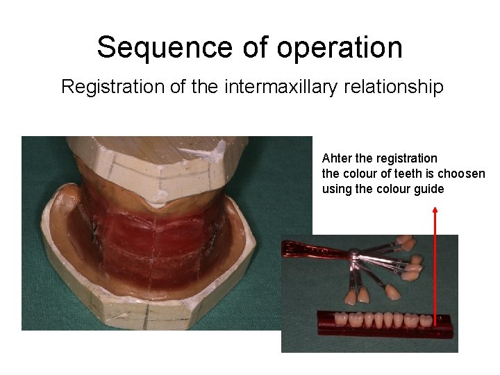 Sequence of operation Registration of the intermaxillary relationship Ahter the registration the colour of