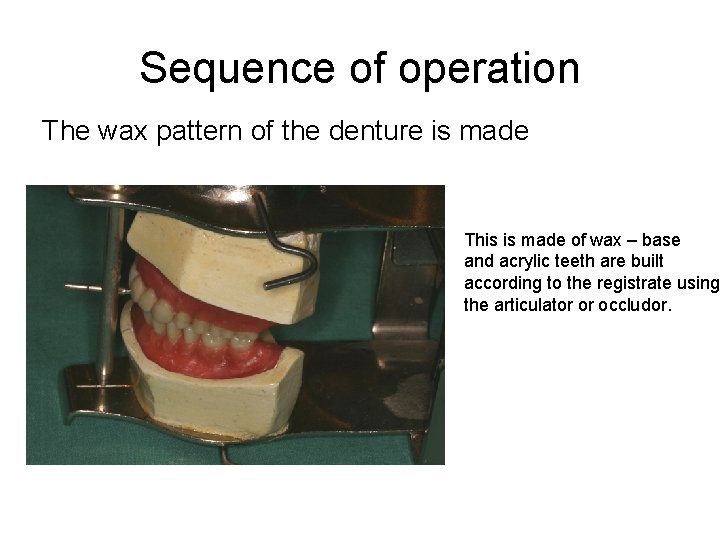 Sequence of operation The wax pattern of the denture is made This is made