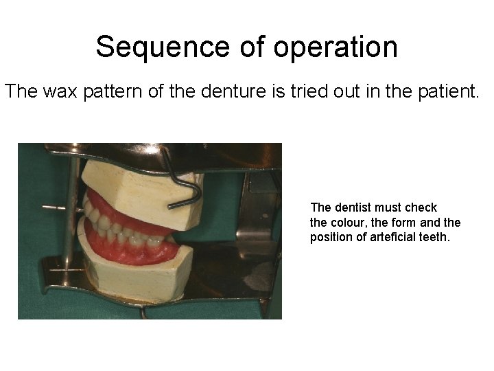 Sequence of operation The wax pattern of the denture is tried out in the