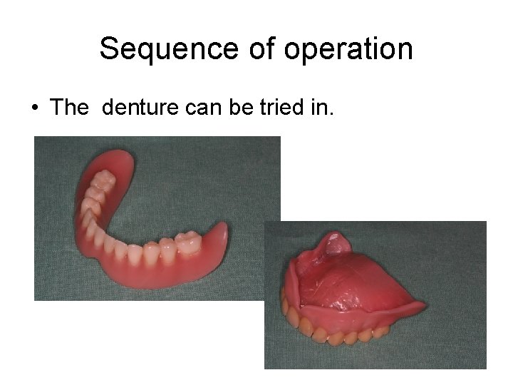 Sequence of operation • The denture can be tried in. 