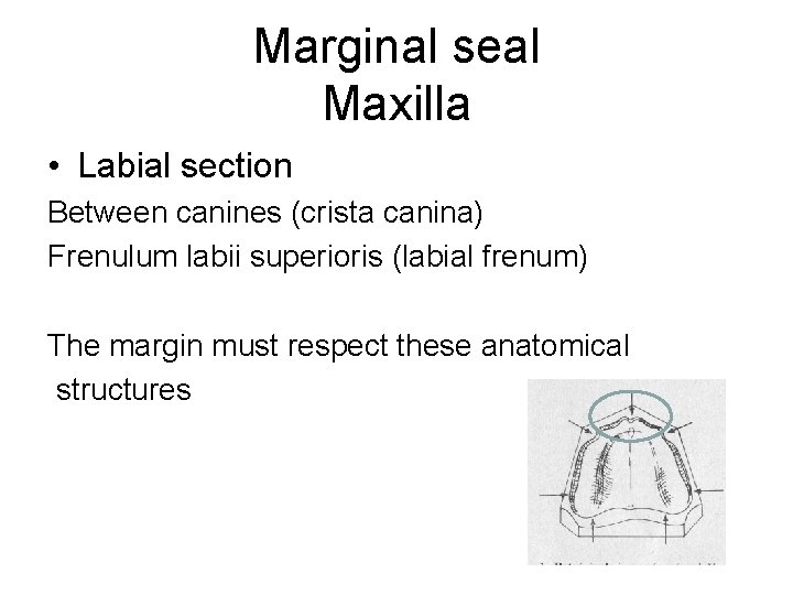 Marginal seal Maxilla • Labial section Between canines (crista canina) Frenulum labii superioris (labial