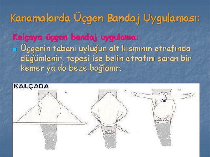 Kanamalarda Üçgen Bandaj Uygulaması: Kalçaya üçgen bandaj uygulama: n Üçgenin tabanı uyluğun alt kısmının