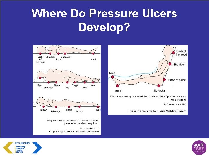 Where Do Pressure Ulcers Develop? 
