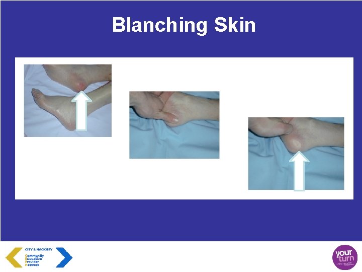 Blanching Skin 