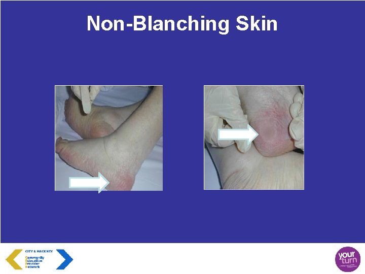 Non-Blanching Skin 