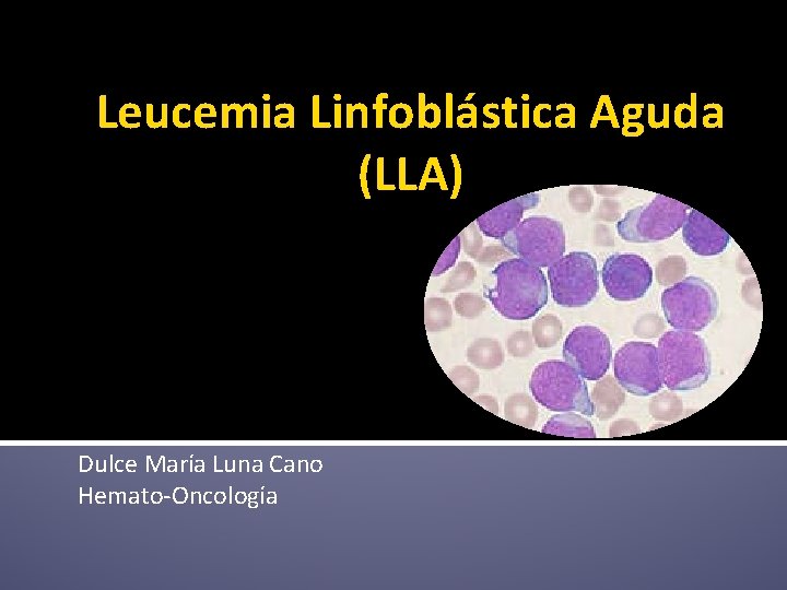 Leucemia Linfoblástica Aguda (LLA) Dulce María Luna Cano Hemato-Oncología 