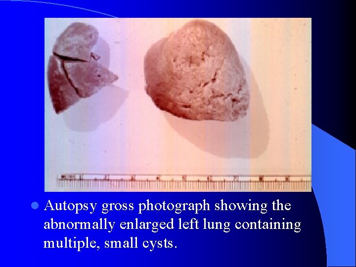 l Autopsy gross photograph showing the abnormally enlarged left lung containing multiple, small cysts.