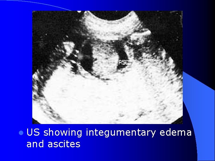 l US showing integumentary edema and ascites 