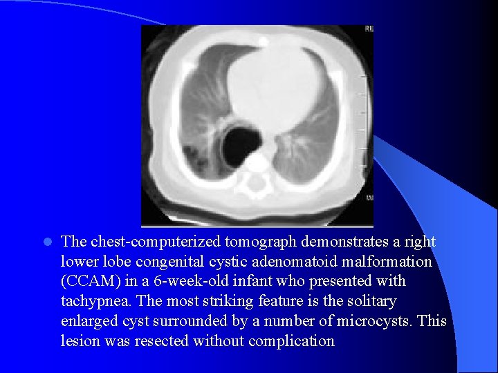 l The chest-computerized tomograph demonstrates a right lower lobe congenital cystic adenomatoid malformation (CCAM)
