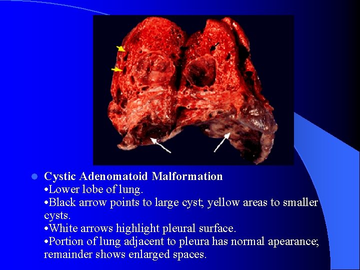  l Cystic Adenomatoid Malformation • Lower lobe of lung. • Black arrow points