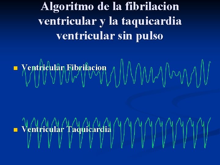 Algoritmo de la fibrilacion ventricular y la taquicardia ventricular sin pulso n Ventricular Fibrilacion