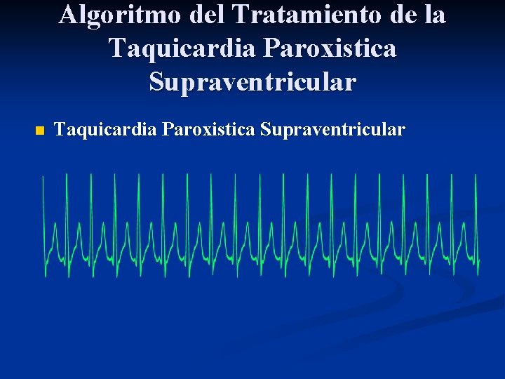 Algoritmo del Tratamiento de la Taquicardia Paroxistica Supraventricular n Taquicardia Paroxistica Supraventricular 