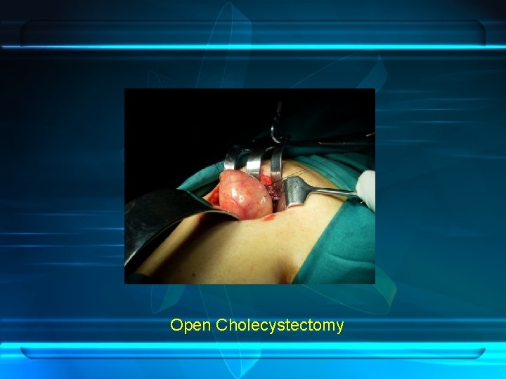 Open Cholecystectomy 