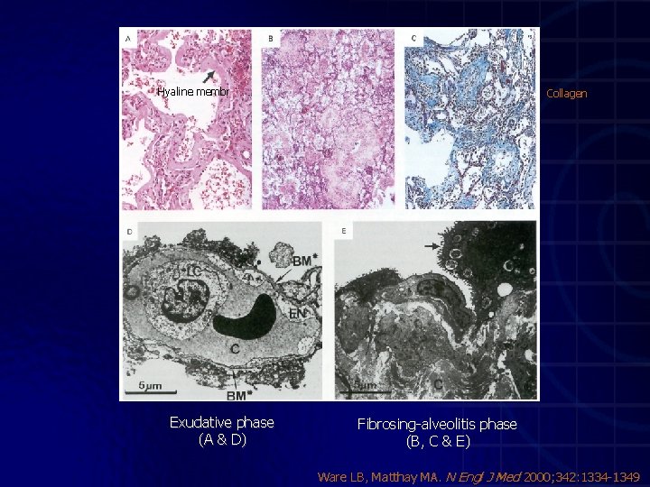 Hyaline membr Exudative phase (A & D) Collagen Fibrosing-alveolitis phase (B, C & E)