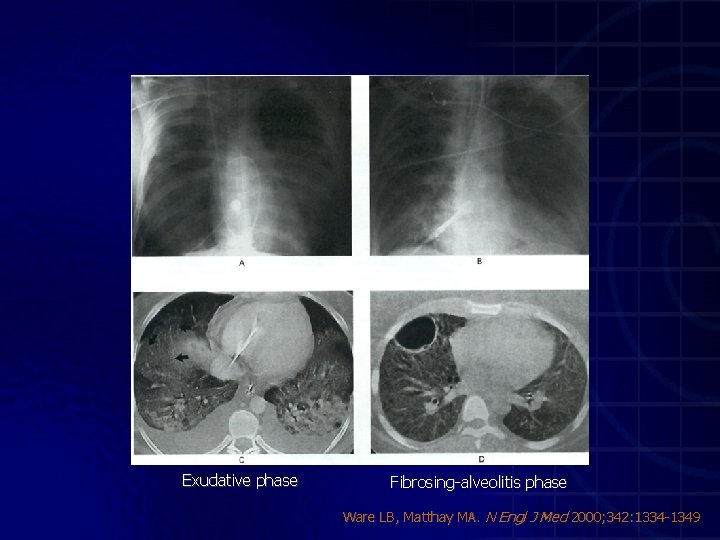 Exudative phase Fibrosing-alveolitis phase Ware LB, Matthay MA. N Engl J Med 2000; 342: