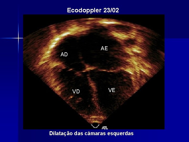 Ecodoppler 23/02 AE AD VD VE Dilatação das câmaras esquerdas 
