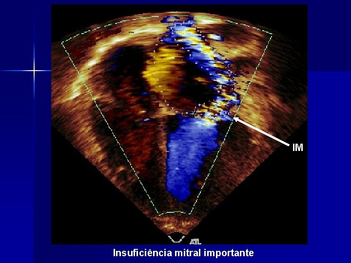 IM Insuficiência mitral importante 