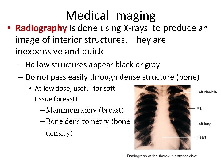 Medical Imaging • Radiography is done using X-rays to produce an image of interior