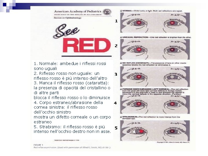 1. Normale: ambedue i riflessi rossi sono uguali 2. Riflesso rosso non uguale: un