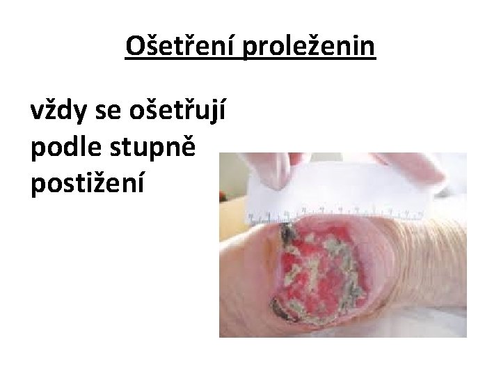 Ošetření proleženin vždy se ošetřují podle stupně postižení 