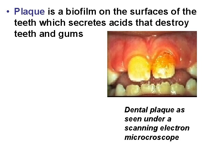  • Plaque is a biofilm on the surfaces of the teeth which secretes