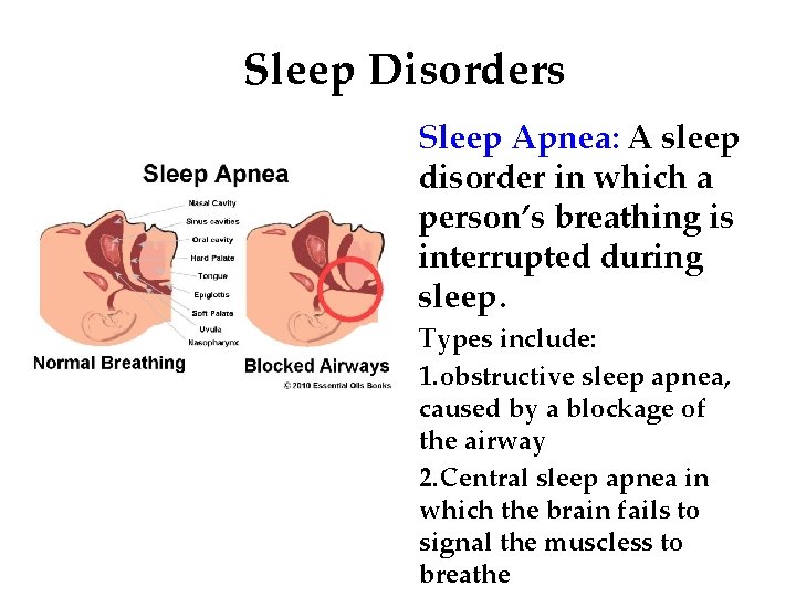 Sleep Disorders Sleep Apnea: A sleep disorder in which a person’s breathing is interrupted