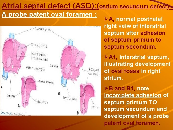 Atrial septal defect (ASD): (ostium secundum defect) A probe patent oval foramen : ØA, Atrial septal defect (ASD): (ostium secundum defect) A probe patent oval foramen : ØA,