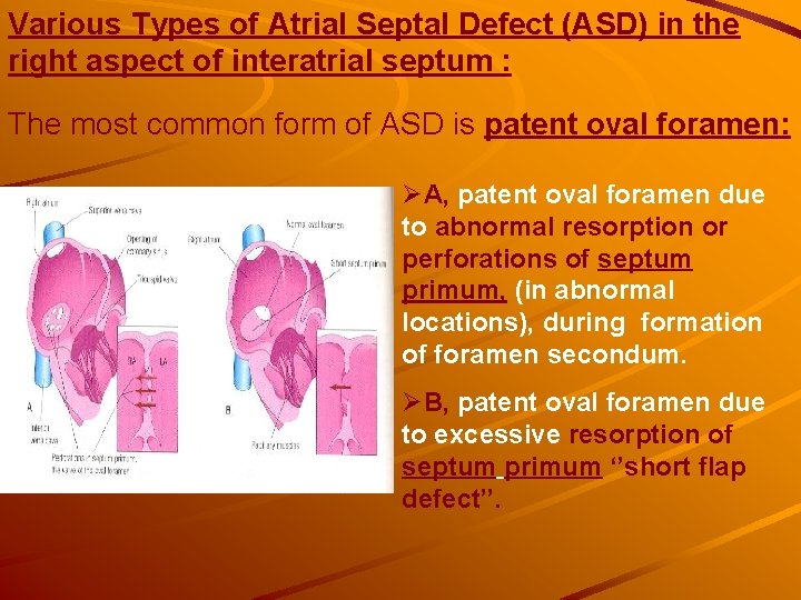 Various Types of Atrial Septal Defect (ASD) in the right aspect of interatrial septum Various Types of Atrial Septal Defect (ASD) in the right aspect of interatrial septum