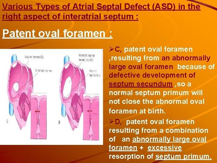 Various Types of Atrial Septal Defect (ASD) in the right aspect of interatrial septum Various Types of Atrial Septal Defect (ASD) in the right aspect of interatrial septum