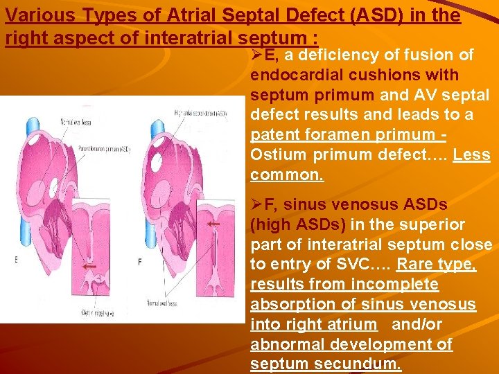 Various Types of Atrial Septal Defect (ASD) in the right aspect of interatrial septum Various Types of Atrial Septal Defect (ASD) in the right aspect of interatrial septum