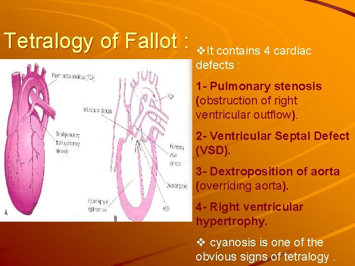 Tetralogy of Fallot : v. It contains 4 cardiac defects : 1 - Pulmonary Tetralogy of Fallot : v. It contains 4 cardiac defects : 1 - Pulmonary