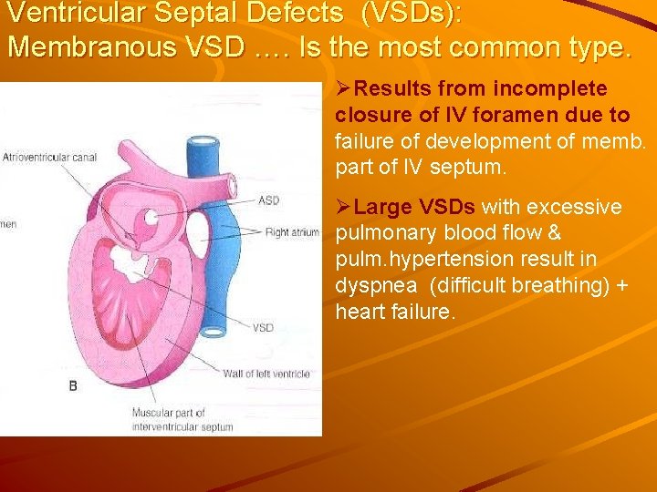 Ventricular Septal Defects (VSDs): Membranous VSD …. Is the most common type. ØResults from Ventricular Septal Defects (VSDs): Membranous VSD …. Is the most common type. ØResults from