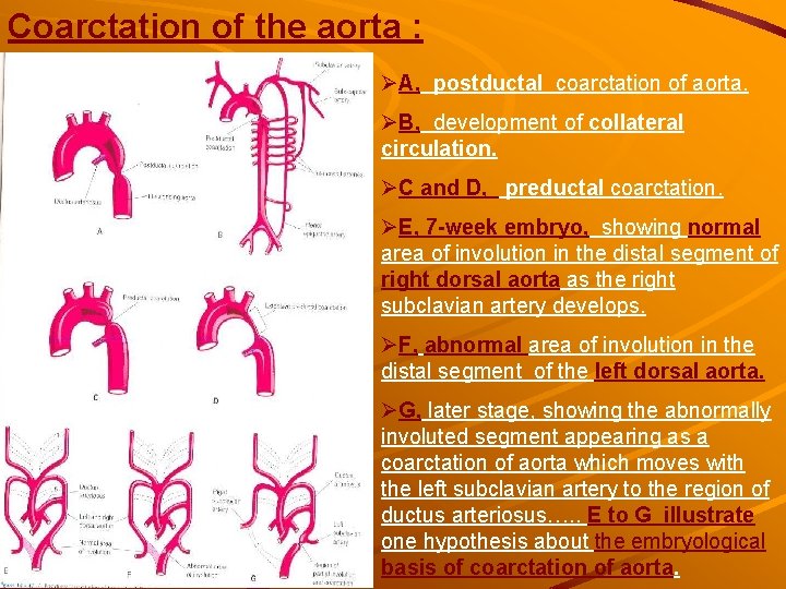 Coarctation of the aorta : ØA, postductal coarctation of aorta. ØB, development of collateral Coarctation of the aorta : ØA, postductal coarctation of aorta. ØB, development of collateral