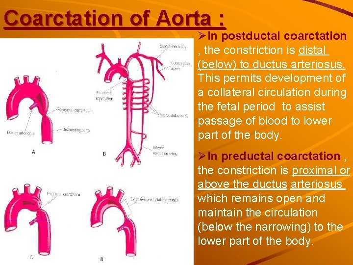 Coarctation of Aorta : ØIn postductal coarctation , the constriction is distal (below) to Coarctation of Aorta : ØIn postductal coarctation , the constriction is distal (below) to