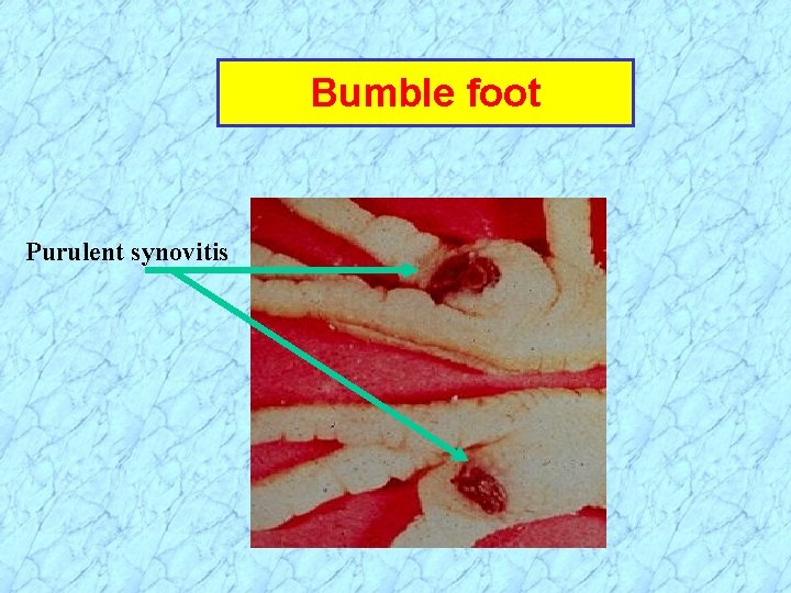 Bumble foot Purulent synovitis 