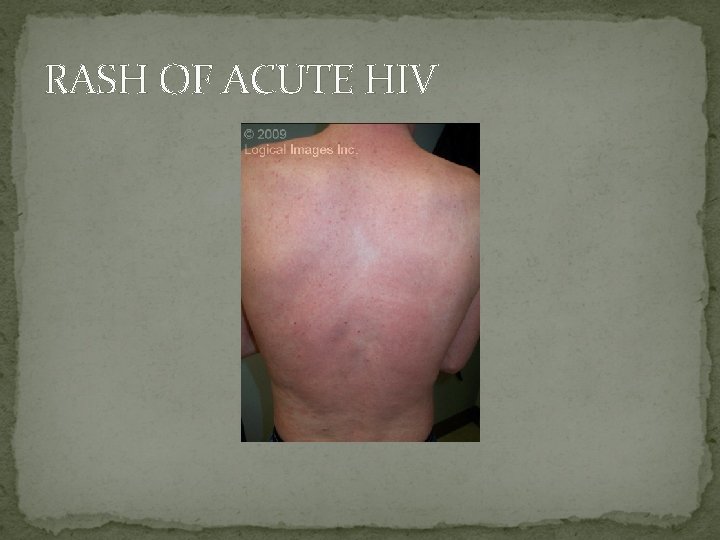 RASH OF ACUTE HIV 