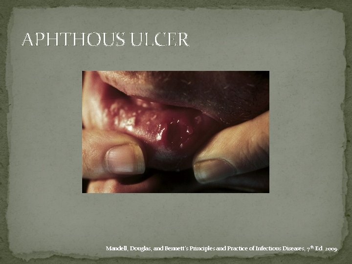 APHTHOUS ULCER Mandell, Douglas, and Bennett's Principles and Practice of Infectious Diseases, 7 th