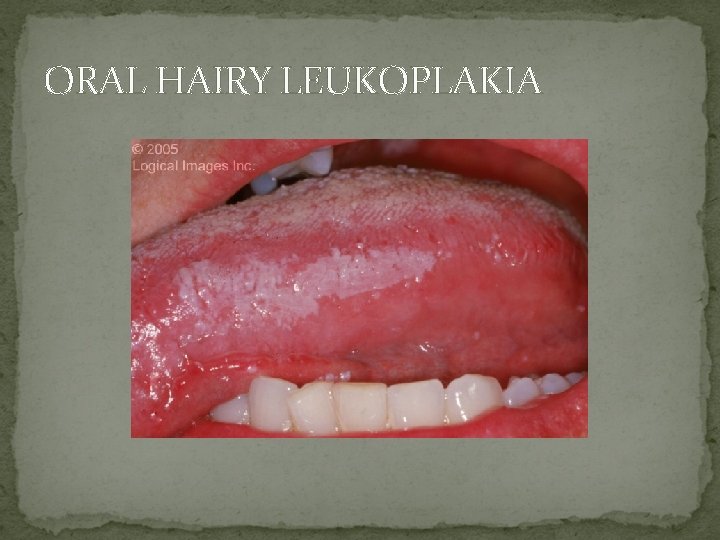 ORAL HAIRY LEUKOPLAKIA 