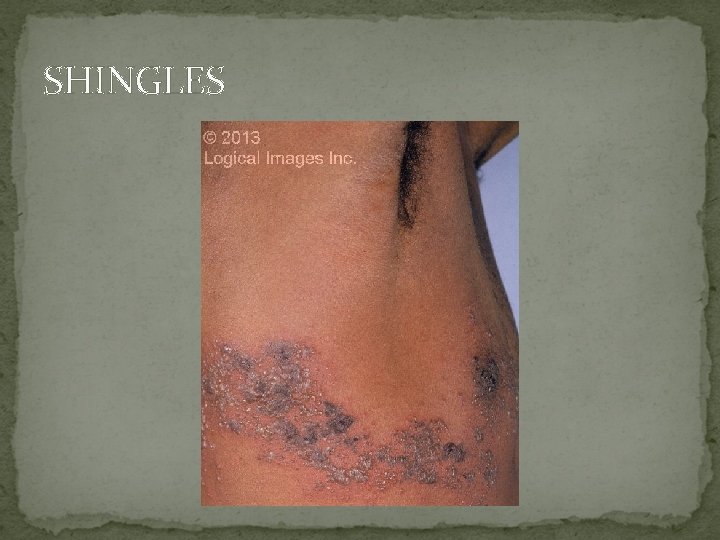 SHINGLES 