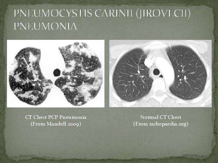 PNEUMOCYSTIS CARINII (JIROVECII) PNEUMONIA CT Chest PCP Pneumonia (From Mandell 2009) Normal CT Chest