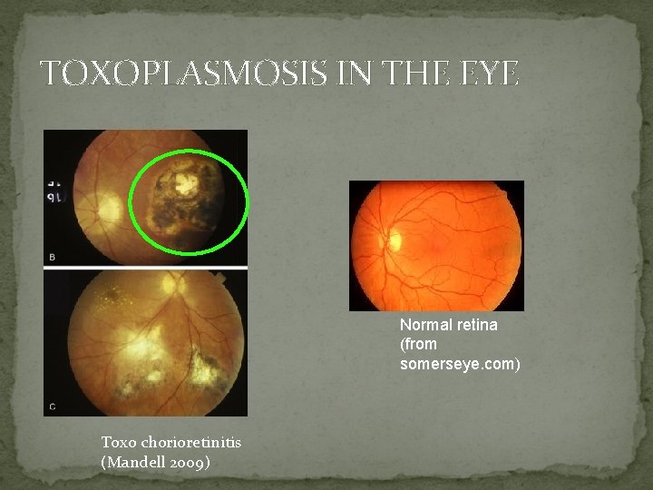 TOXOPLASMOSIS IN THE EYE Normal retina (from somerseye. com) Toxo chorioretinitis (Mandell 2009) 
