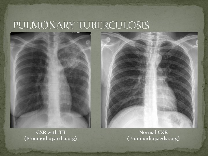 PULMONARY TUBERCULOSIS CXR with TB (From radiopaedia. org) Normal CXR (From radiopaedia. org) 