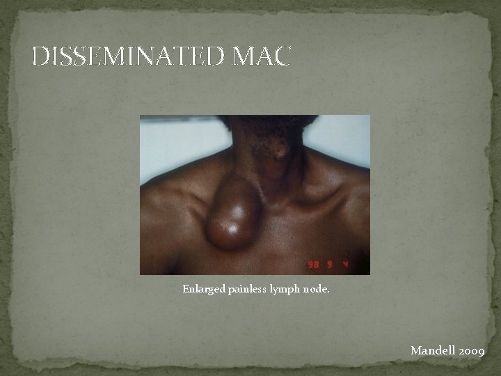 DISSEMINATED MAC Enlarged painless lymph node. Mandell 2009 
