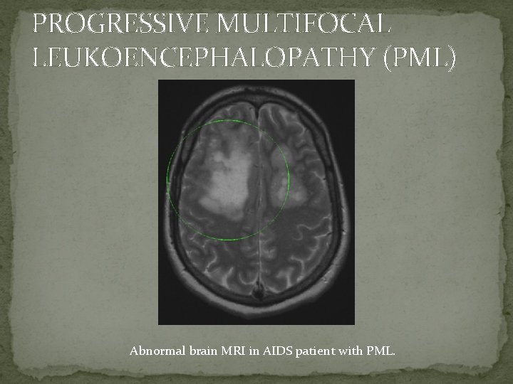 PROGRESSIVE MULTIFOCAL LEUKOENCEPHALOPATHY (PML) Abnormal brain MRI in AIDS patient with PML. 