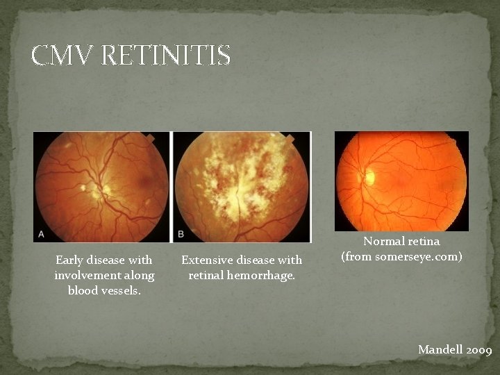 CMV RETINITIS Early disease with involvement along blood vessels. Extensive disease with retinal hemorrhage.