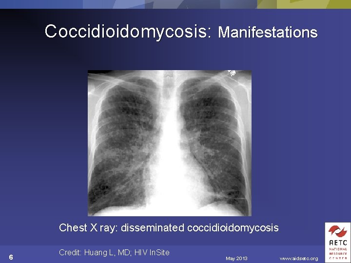 Coccidioidomycosis: Manifestations Chest X ray: disseminated coccidioidomycosis 6 Credit: Huang L, MD; HIV In.