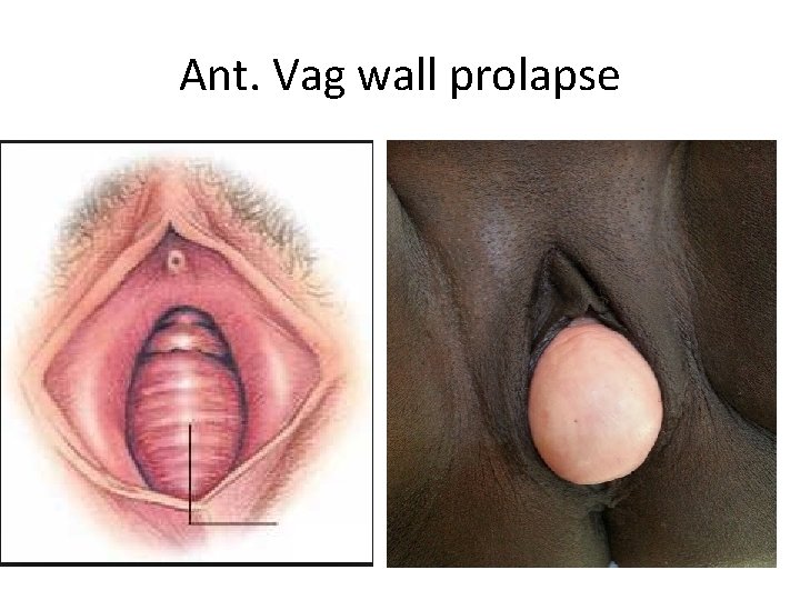Ant. Vag wall prolapse 